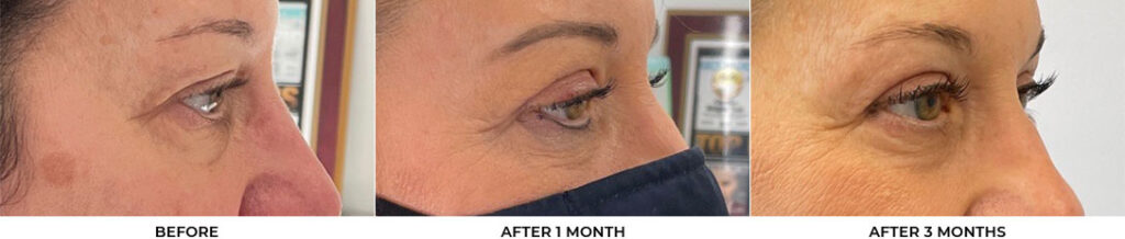 55 year old woman who was bothered by her upper eyelid appearance. She underwent in-office upper eyelid blepharoplasty and CO2 skin resurfacing. After photos show progression at 1 month and 3 months post-surgery. Results can last 10 years.				
