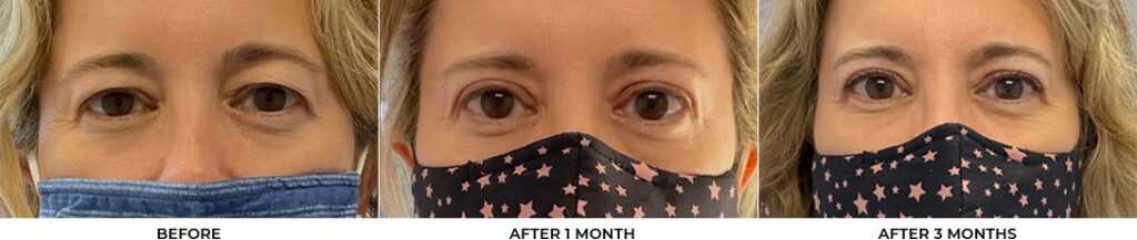 48 year old woman who was bothered by her upper eyelid appearance. She underwent in-office upper eyelid blepharoplasty. After photos show progression at 1 month and 3 months post-surgery. Results can last 10 years.				