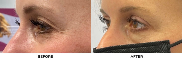 39 year old woman who was bothered by upper eyelid appearance. She underwent upper eyelid blepharoplasty in-office under local anesthesia. After photos were obtained 1-month post-surgery. Results can last 10 years.				