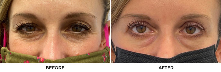 39 year old woman who was bothered by upper eyelid appearance. She underwent upper eyelid blepharoplasty in-office under local anesthesia. After photos were obtained 1-month post-surgery. Results can last 10 years.				