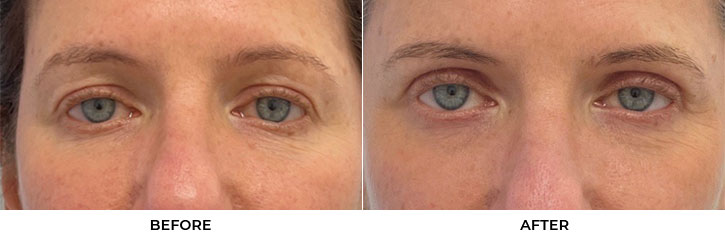 54 year old woman who was bothered by upper eyelid appearance. She underwent upper eyelid blepharoplasty with CO2 resurfacing in-office under local anesthesia. After photos display results 4 months post-surgery. Results can last 10 years.				