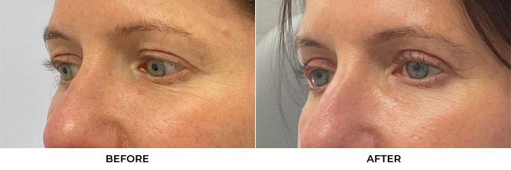 54 year old woman who was bothered by upper eyelid appearance. She underwent upper eyelid blepharoplasty with CO2 resurfacing in-office under local anesthesia. After photos display results 4 months post-surgery. Results can last 10 years.				