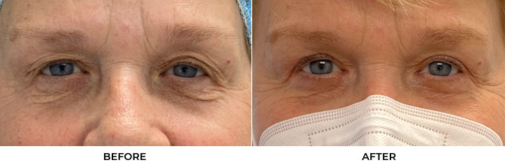 64 year old woman who was bothered by upper eyelid appearance. She underwent upper eyelid blepharoplasty with lower eyelid skin pinch blepharoplasty in-office under local anesthesia. After photos obtained 6 months post-surgery. Results can last 10 years.				