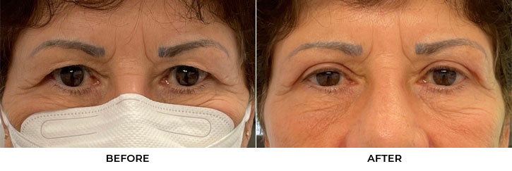 70 year old woman who was bothered by her upper eyelid appearance. She underwent upper eyelid blepharoplasty and internal browpexy. After photos are from 2 months post-surgery. Results can last 10 years.				