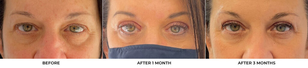 55 year old woman who was bothered by her upper eyelid appearance. She underwent in-office upper eyelid blepharoplasty and CO2 skin resurfacing. After photos show progression at 1 month and 3 months post-surgery. Results can last 10 years.				