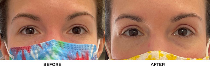 35 year old woman who was bothered by her upper eyelid appearance. She underwent in-office upper eyelid blepharoplasty. After photos show progression at 1 month post-surgery. Results can last 10 years.				