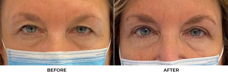 67 year old woman who was bothered by her upper eyelid appearance. She underwent in-office upper eyelid blepharoplasty. After photos show progression at 1 month post-surgery. Results can last 10 years.				