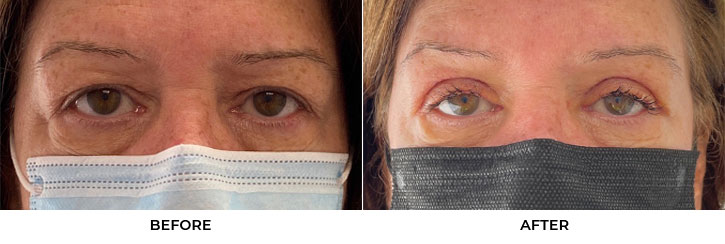 64 year old woman who was bothered by her upper eyelid appearance. She underwent in-office upper eyelid blepharoplasty. After photos show results at 1 week post-surgery. Swelling will gradually resolve over the next several weeks.				