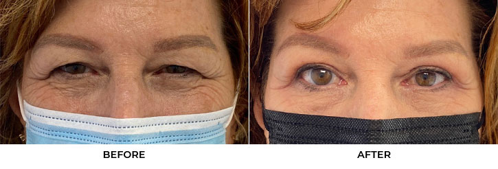 58 year old woman who was bothered by her upper eyelid appearance. She underwent in-office upper eyelid blepharoplasty and internal browpexy. After photos show results at 1 month post-surgery. Results can last 10 years.				