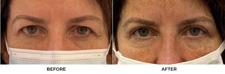 55 year old woman who was bothered by her upper eyelid appearance. She underwent upper eyelid blepharoplasty and internal browpexy. After photos show results at 3 months post-surgery.				