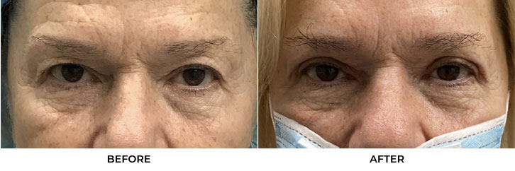 62 year old woman who was bothered by her upper eyelid appearance. She underwent upper eyelid blepharoplasty. After photos show results at 3 months post-surgery.				