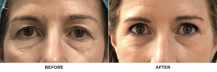 60 year old woman who was bothered by her upper eyelid appearance. She underwent upper eyelid blepharoplasty. After photos show results at 3 months post-surgery.				