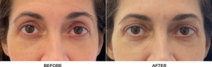 48 year old woman who was bothered by hollowing of the upper eyelids. She underwent filler placement to the upper eyelids. After photos are immediately post-treatment.				