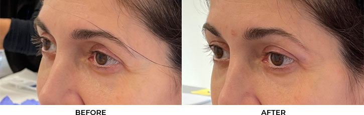 48 year old woman who was bothered by hollowing of the upper eyelids. She underwent filler placement to the upper eyelids. After photos are immediately post-treatment.				