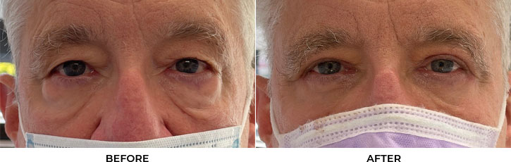 65 year old man who was bothered by the appearance of his upper and lower eyelids. He underwent upper and lower eyelid blepharoplasty with internal browpexy, mid-face SOOF lift, and CO2 resurfacing. After photos are 2 months post-procedure. Results typically last 7-10 years.				