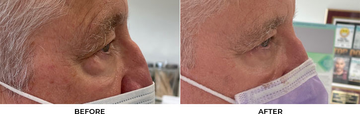 65 year old man who was bothered by the appearance of his upper and lower eyelids. He underwent upper and lower eyelid blepharoplasty with internal browpexy, mid-face SOOF lift, and CO2 resurfacing. After photos are 2 months post-procedure. Results typically last 7-10 years.				