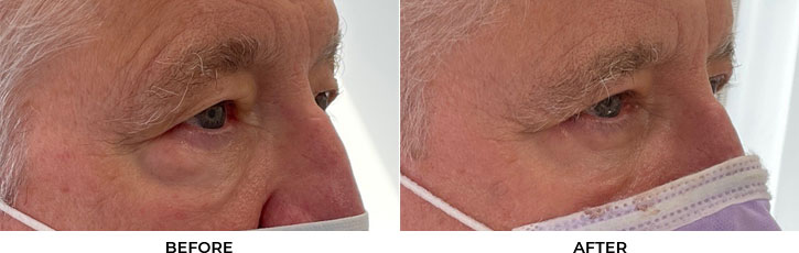 65 year old man who was bothered by the appearance of his upper and lower eyelids. He underwent upper and lower eyelid blepharoplasty with internal browpexy, mid-face SOOF lift, and CO2 resurfacing. After photos are 2 months post-procedure. Results typically last 7-10 years.				