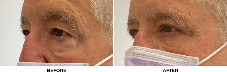 65 year old man who was bothered by the appearance of his upper and lower eyelids. He underwent upper and lower eyelid blepharoplasty with internal browpexy, mid-face SOOF lift, and CO2 resurfacing. After photos are 2 months post-procedure. Results typically last 7-10 years.				