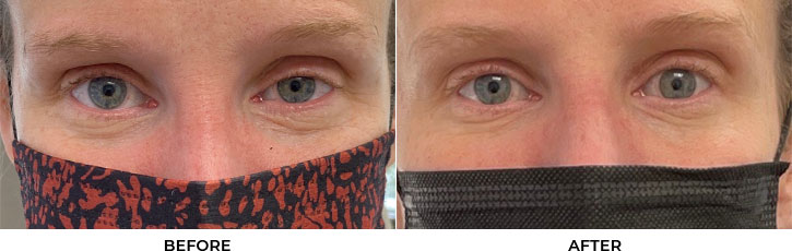36 year old woman who was bothered by drooping of the left upper eyelid. She underwent internal ptosis repair. After photos are 1 month post-left upper eyelid ptosis repair. Results can last 10 years.				