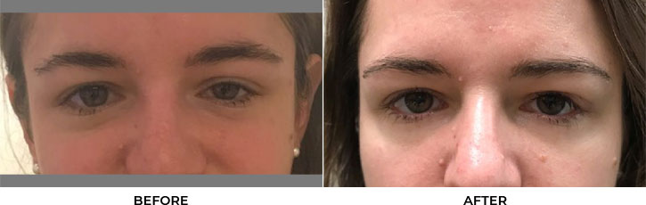 30 year old woman who was bothered by drooping of the left upper eyelid. She underwent external ptosis repair. After photos are 1 month post-left upper eyelid ptosis repair. Results can last 10 years.				