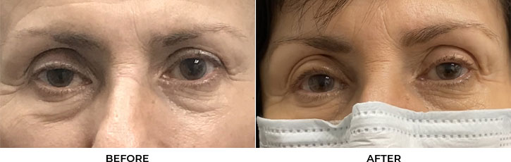 56 year old woman who was bothered by drooping of the right upper eyelid. She underwent external ptosis repair. After photos are 1 month post-right upper eyelid ptosis repair. Results can last 10 years.				