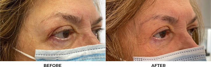 Revision Blepharoplasty - Patient 1B