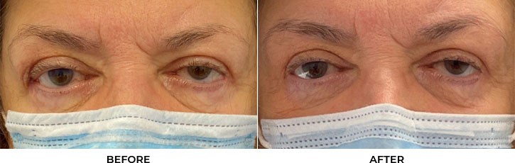 Revision Blepharoplasty - Patient 1A