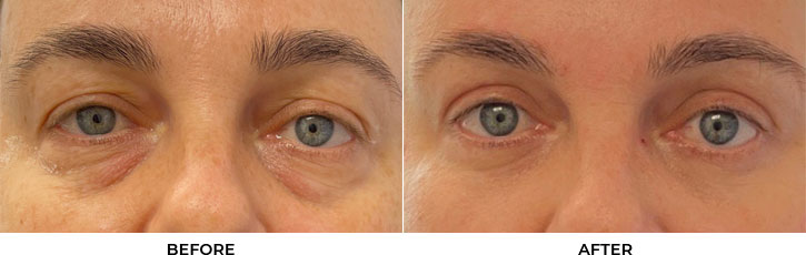50 year old woman who was bothered by her upper and lower eyelid appearance. She underwent upper and lower eyelid blepharoplasty and CO2 resurfacing. After photos are from 3 months post-surgery. Results can last 10 years.				
