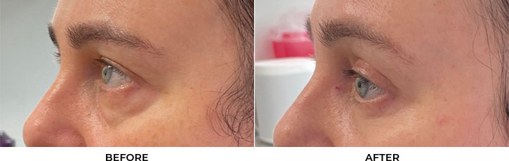 50 year old woman who was bothered by her upper and lower eyelid appearance. She underwent upper and lower eyelid blepharoplasty and CO2 resurfacing. After photos are from 3 months post-surgery. Results can last 10 years				