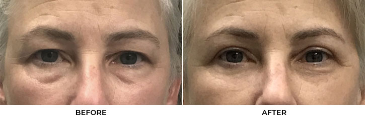 50 year old woman who was bothered by her upper and lower eyelid appearance. She underwent upper and lower eyelid blepharoplasty. After photos are 3 months post-surgery. Results can last 10 years.				