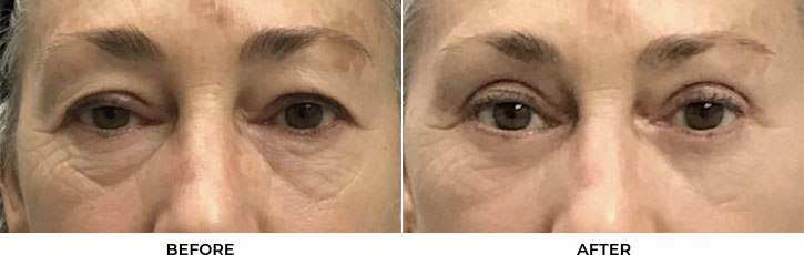 50 year old woman who was bothered by her upper and lower eyelid appearance. She underwent upper and lower eyelid blepharoplasty. After photos are 3 months post-surgery. Results can last 10 years.				