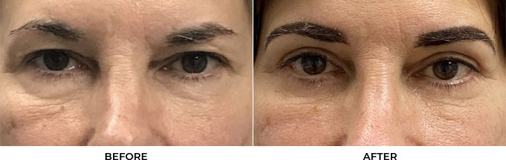 52 year old woman who was bothered by her upper and lower eyelid appearance. She underwent upper and lower eyelid blepharoplasty with mini cheek lift. After photos are 3 months post-surgery. Results can last 10 years.				