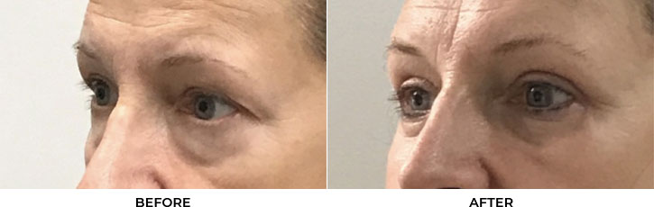 56 year old woman who was bothered by her upper and lower eyelid appearance. She underwent upper and lower eyelid blepharoplasty. After photos are 3 months post-surgery. Results can last 10 years.				