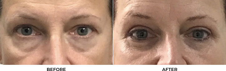 56 year old woman who was bothered by her upper and lower eyelid appearance. She underwent upper and lower eyelid blepharoplasty. After photos are 3 months post-surgery. Results can last 10 years.				