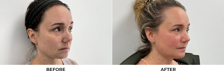 50 year old woman who was bothered by her mild double chin and jawline, underwent in-office FaceTite to improve jawline contour. After photos obtained 3 months post-procedure, results typically last 5-7 years.				