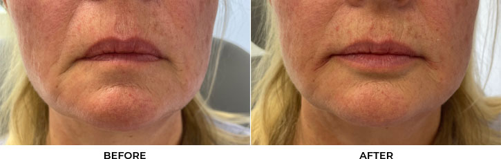 64 year old woman who was bothered by lip volume asymmetry. She underwent filler placement for lip augmentation. After photos are immediately post-treatment.				