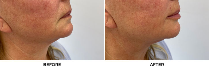 64 year old woman who was bothered by lip volume asymmetry. She underwent filler placement for lip augmentation. After photos are immediately post-treatment.				