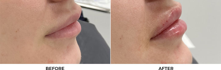 28 year old woman who was seeking larger lip volume. She underwent filler placement for lip augmentation. After photos are immediately post-treatment.				