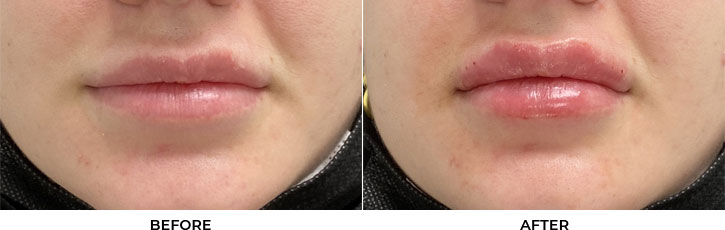 28 year old woman who was seeking larger lip volume. She underwent filler placement for lip augmentation. After photos are immediately post-treatment.				