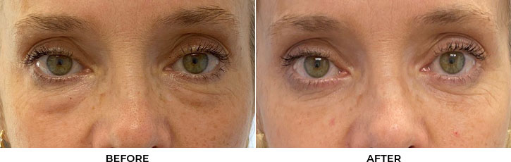 55 year old woman who was bothered by the appearance of her lower eyelids. She underwent transconjunctival lower eyelid blepharoplasty. After photos were obtained 3 months after surgery. Results can last 10 years.				