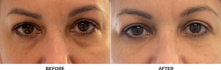 50 year old woman who was bothered by the appearance of her lower eyelids. She underwent transconjunctival lower eyelid blepharoplasty. After photos were obtained 4 months after surgery. Results can last 10 years.				