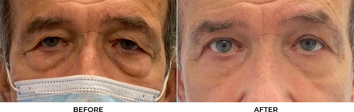 72 year old man who was bothered by the appearance of his upper and lower eyelids. He underwent upper and lower eyelid blepharoplasty and endoscopic brow lift. After photos are 3 months post-procedure. Results typically last 7-10 years.				