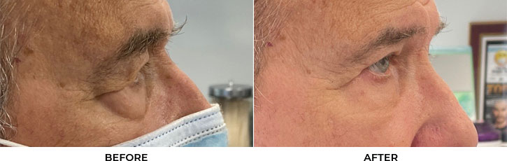 72 year old man who was bothered by the appearance of his upper and lower eyelids. He underwent upper and lower eyelid blepharoplasty and endoscopic brow lift. After photos are 3 months post-procedure. Results typically last 7-10 years.				