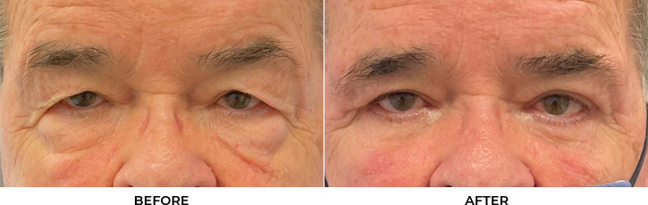 77 year old man who was bothered by the appearance of his upper and lower eyelids. He underwent upper and lower eyelid blepharoplasty with internal browpexy. After photos are 2 months post-procedure. Results typically last 7-10 years.				