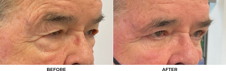 77 year old man who was bothered by the appearance of his upper and lower eyelids. He underwent upper and lower eyelid blepharoplasty with internal browpexy. After photos are 2 months post-procedure. Results typically last 7-10 years.				