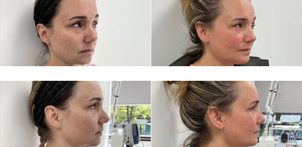 50 year old woman who was bothered by her mild double chin and jawline, underwent in-office FaceTite to improve jawline contour. After photos obtained 3 months post-procedure, results typically last 5-7 years.