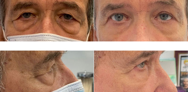 72 year old man who was bothered by the appearance of his upper and lower eyelids. He underwent upper and lower eyelid blepharoplasty and endoscopic brow lift. After photos are 3 months post-procedure. Results typically last 7-10 years.