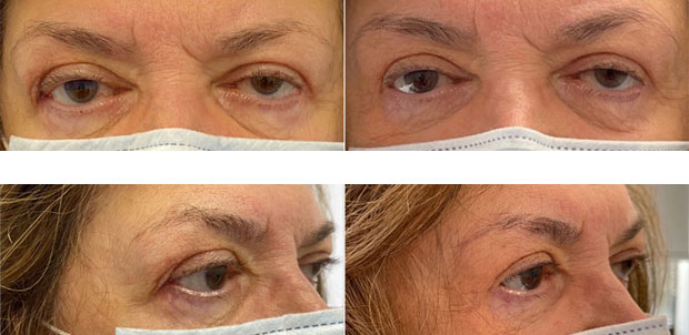 Revision Blepharoplasty Before After Image