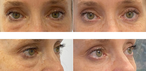 55 year old woman who was bothered by the appearance of her lower eyelids. She underwent transconjunctival lower eyelid blepharoplasty. After photos were obtained 3 months after surgery. Results can last 10 years.