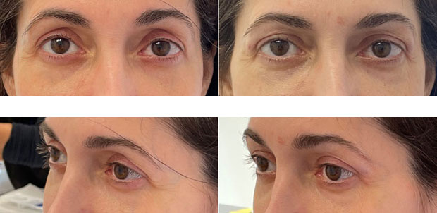 48 year old woman who was bothered by hollowing of the upper eyelids. She underwent filler placement to the upper eyelids. After photos are immediately post-treatment.